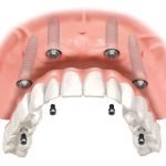Implant Supported Overdenture 4 Implants