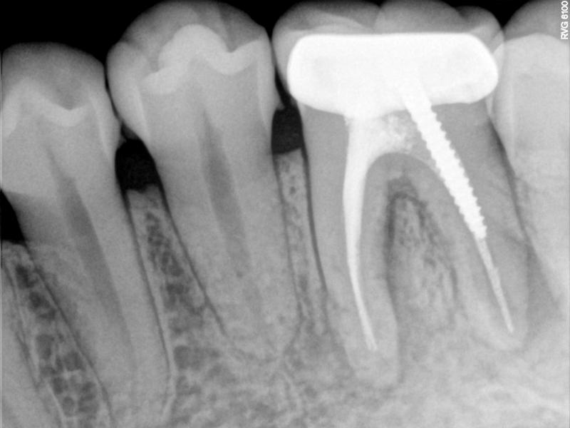 molar root canal