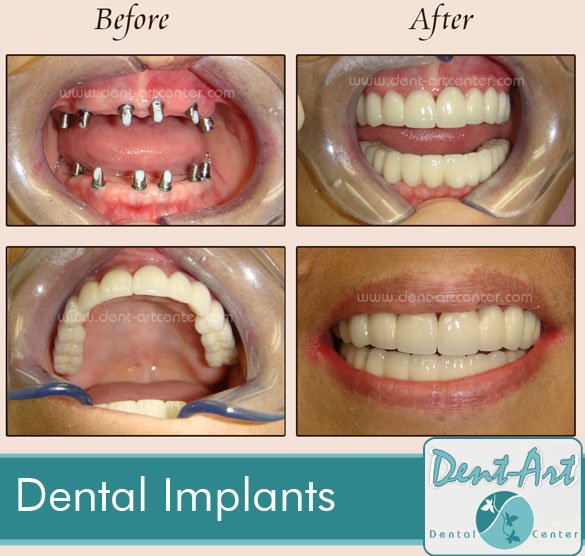 dental-implants3