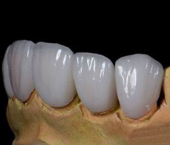 emax crowns