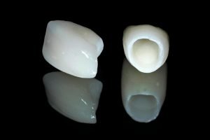 tooth coloured crowns