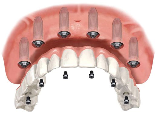 implant supported 6 implants