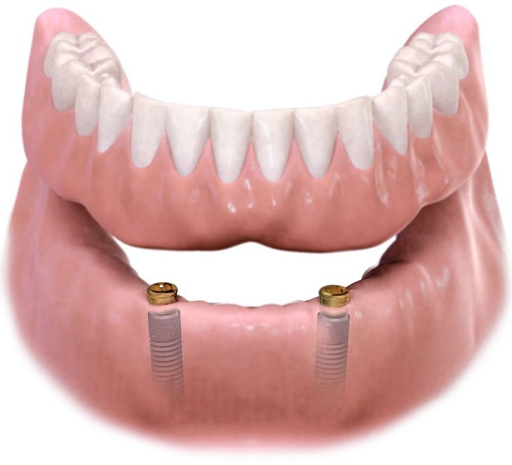 implant supported overdenture 2 implants