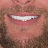 forever dentistry best dentist in san miguel de allende mexico