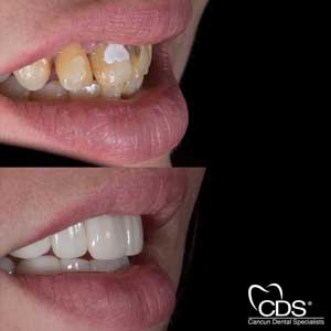 Before After - Cancun Dental Specialists